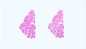 Frozen Tissue Section - Human Tumor: Breast
