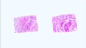 Frozen Tissue Section - Arteriosclerosis Aorta and Matched Non-arteriosclerosis Aorta